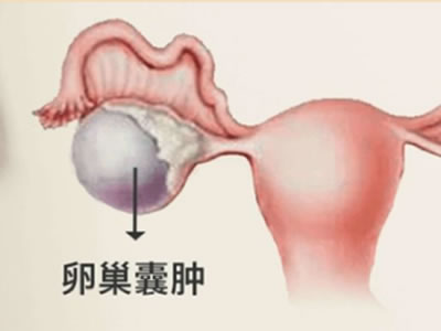 卵巢囊腫會癌變？！不用慌，注意事項在這里
