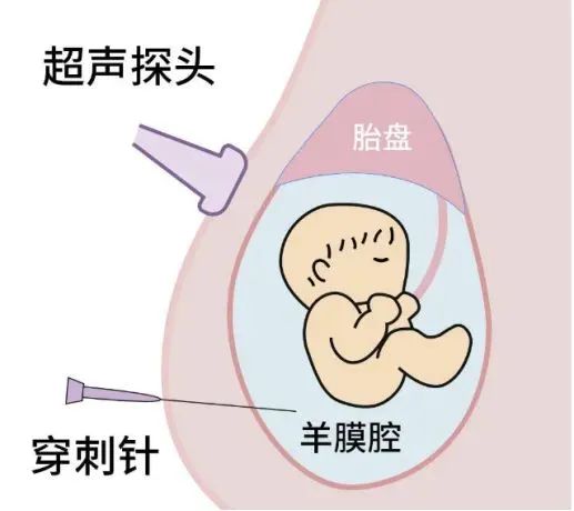 孕期必讀：產(chǎn)前篩查≠產(chǎn)前診斷，區(qū)別在這里！