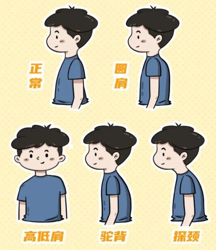 青少年脊柱側(cè)彎：別讓孩子的背，悄悄“彎”了！